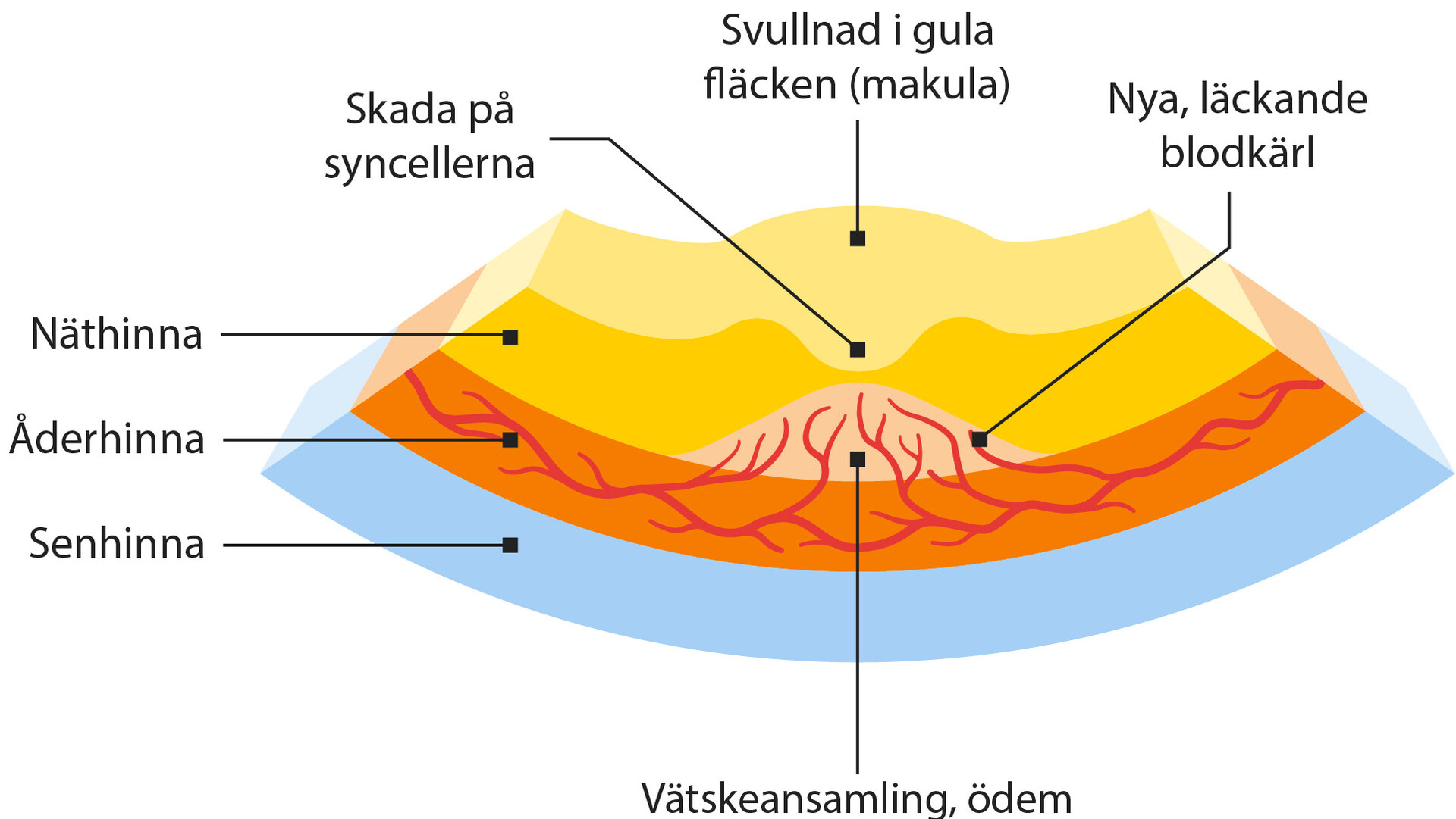 Illustration av vätskeansamling i ögat